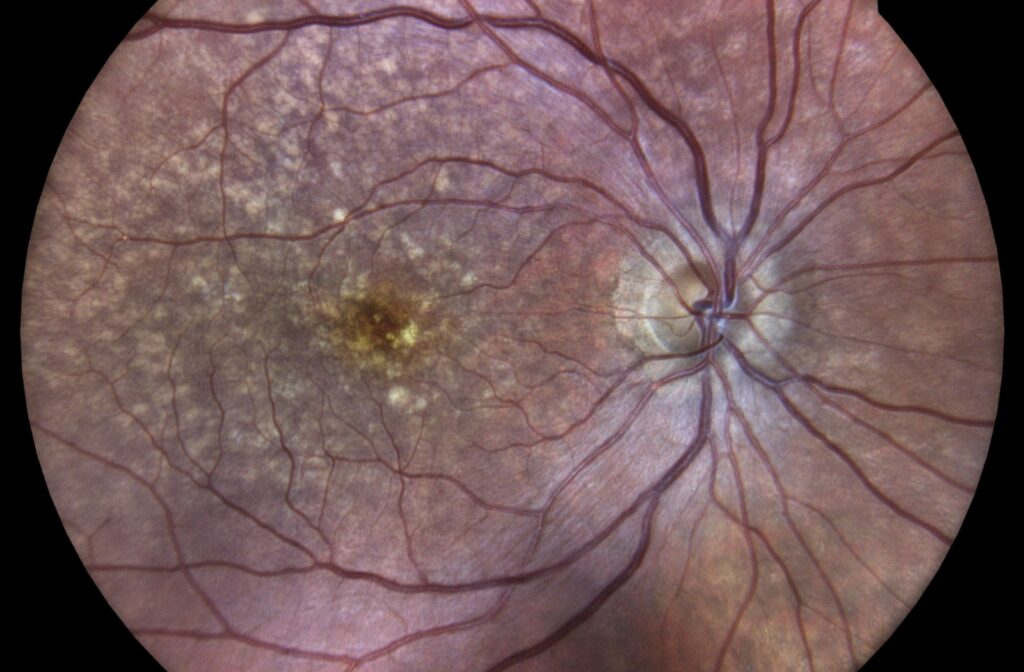 A high definition image of a right eye with dry AMD from the inside. Red, purplish veins spread out from a central point, with a hint of yellow specks towards the center of the eye